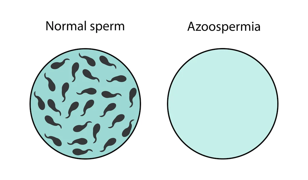 Graphic depicting azoospermia.